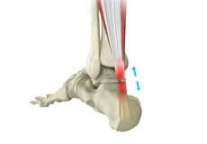 Achilles Tendon Repair