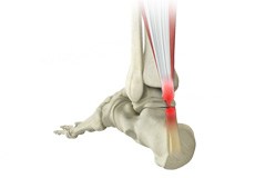 Achilles Tendon Rupture