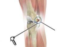 Arthroscopic Reconstruction of the Knee for Ligament Injuries