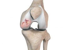 Chondral or Articular Cartilage Defects