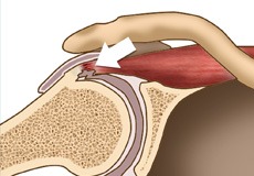 Internal Impingement of the Shoulder