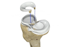 Meniscal Transplantation