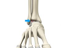 Osteochondral Injuries of the Ankle