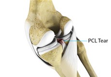 PCL Injuries