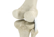 Posterolateral Corner Reconstruction