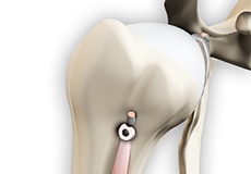 Proximal Biceps Tenodesis