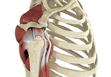 Rotator Cuff Tear