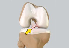 Tibial Eminence Spine Avulsion Fracture