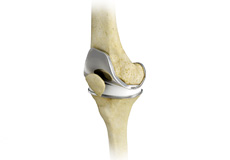 Total Knee Replacement